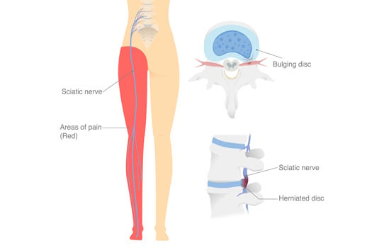 How Long Does It Take the Sciatic Nerve to Heal After Microdiscectomy?